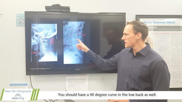 low back pain caused from loss of curvature in the spine
