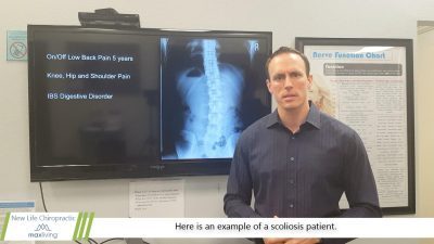 xray of a scoliosis patient before chiropractic treatment
